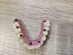 Prothèse sur implant